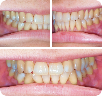Collage of a Lai Orthodontics patient's close-ups of their smile