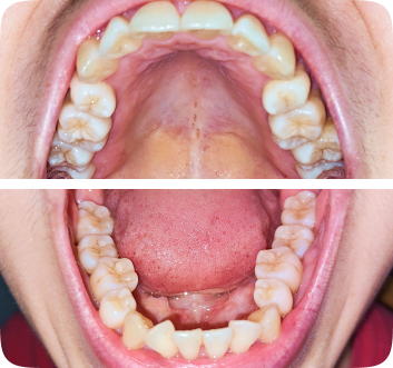 Collage of a Lai Orthodontics patient's close-ups of their teeth
